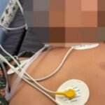 Diduga Setelah Menyantap Menu MBG Hamburger, Siswa Dirawat di Rumah Sakit