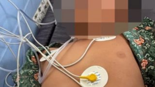 Diduga Setelah Menyantap Menu MBG Hamburger, Siswa Dirawat di Rumah Sakit  Bengkulu